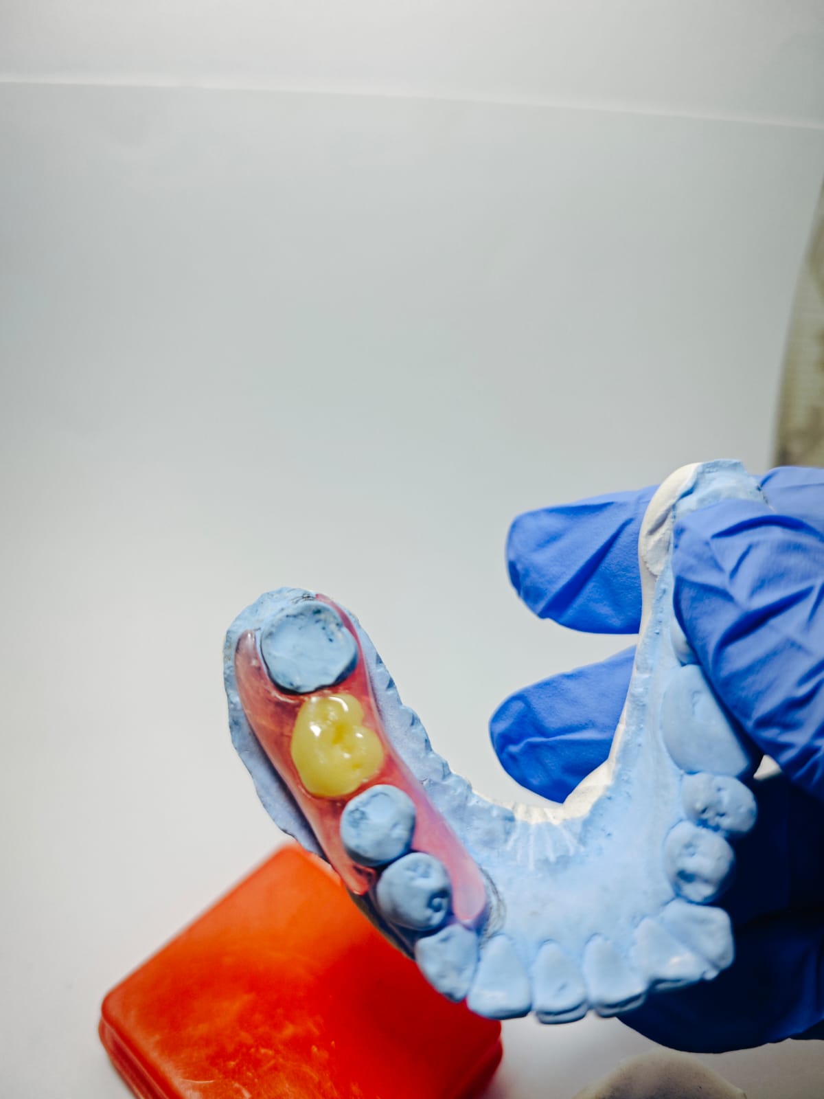 Dokumentasi hasil cetakan gigi palsu Valplast Rofiqi Dental 2