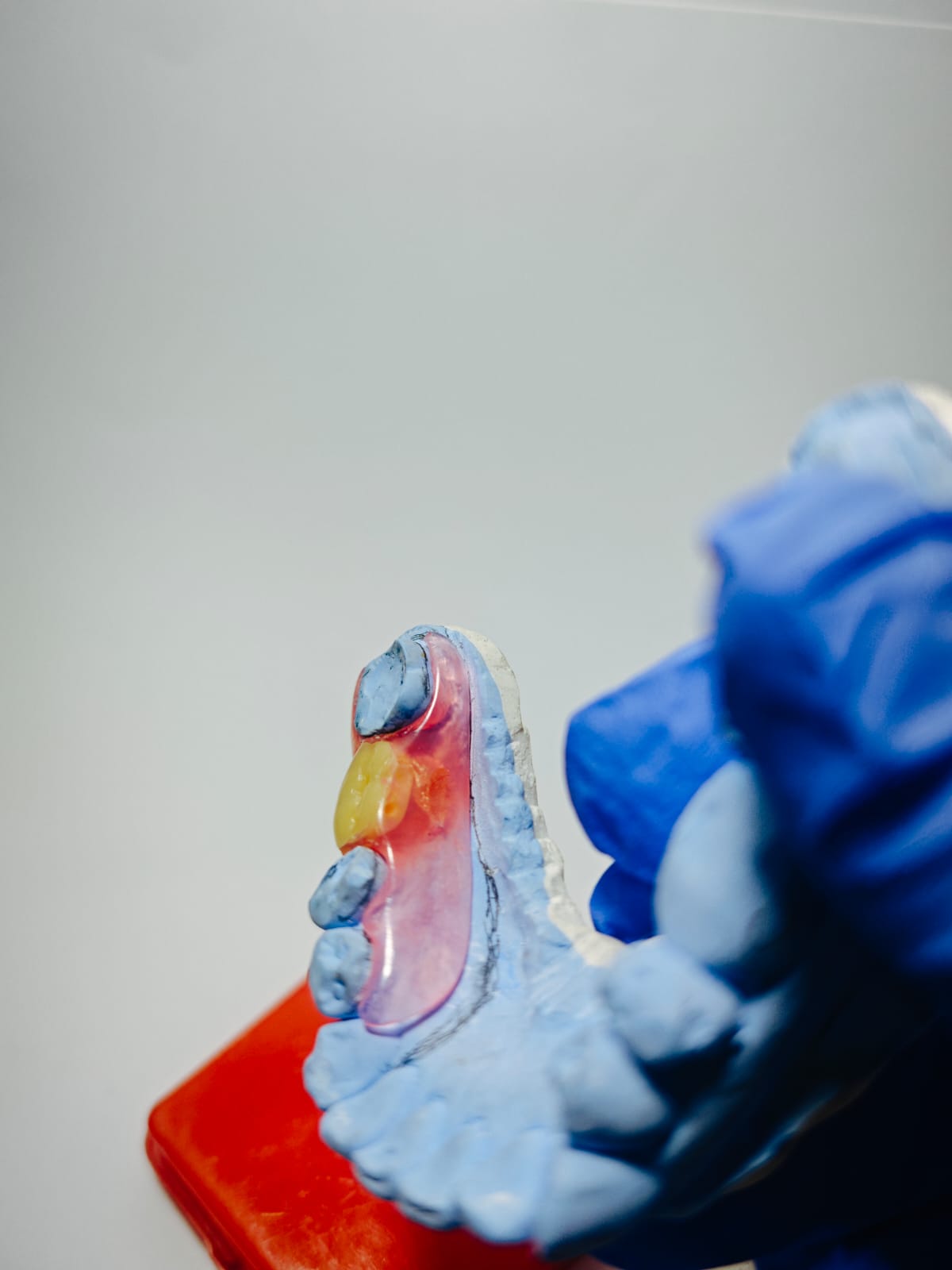Dokumentasi hasil cetakan gigi palsu Valplast Rofiqi Dental 3