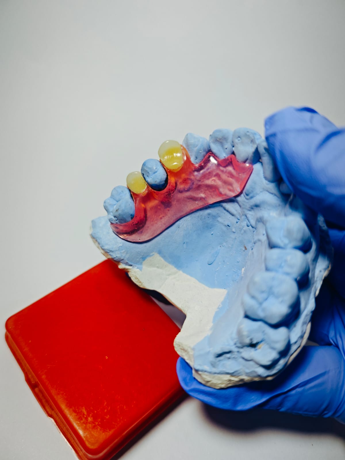 Dokumentasi hasil cetakan gigi palsu Valplast Rofiqi Dental 4