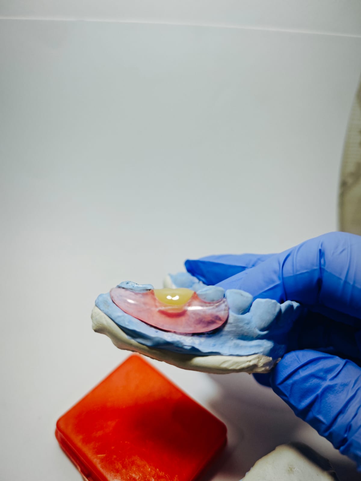 Dokumentasi hasil cetakan gigi palsu Valplast Rofiqi Dental 5